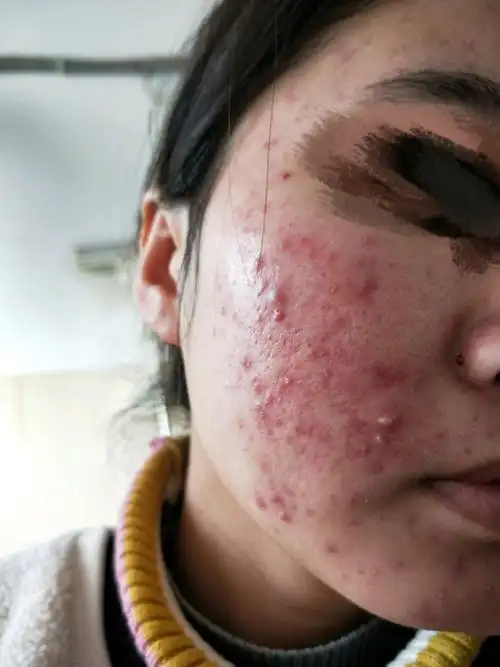 (前两张刷酸前,后两张是一疗程之后)真心建议,烂脸一定要早治疗!