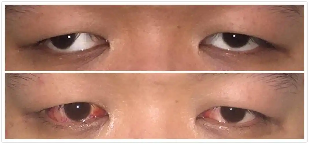 大角度外斜术后外观_眼位