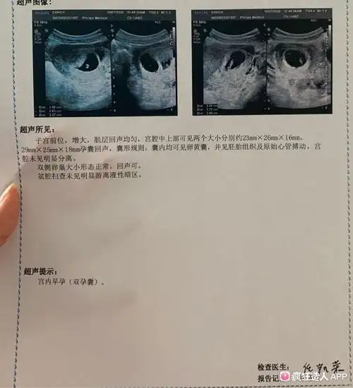 真的是双孕囊啦