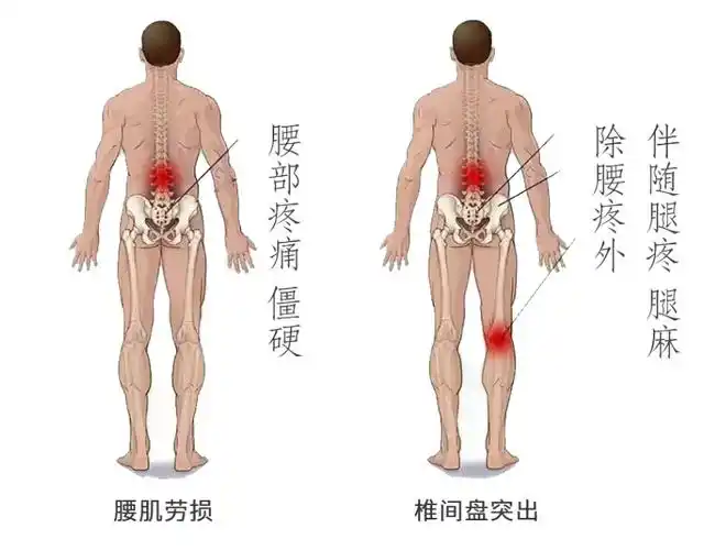 腰突和腰椎间盘突出有什么不同?_肌肉_腰部_症状