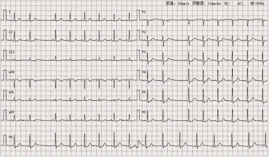 患者女,25岁,图为其产检心电图结论:窦性心律房性早搏未下传分析:分析