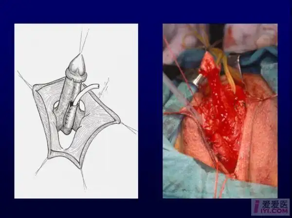 【贴图】变性手术(女变男)