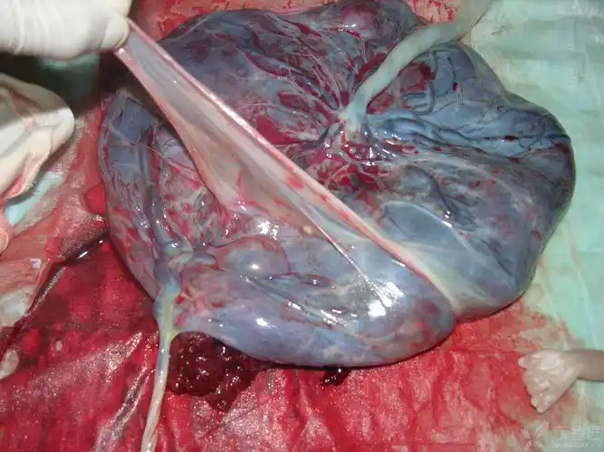 但容易引起羊膜囊带缠绕,引起宫内截肢的风险,此方法目前不提倡使用