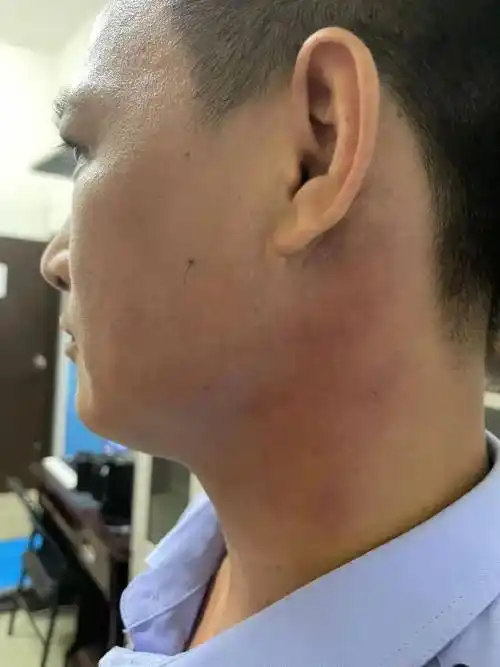 派出所民警的调查工作后,刘俊带着深红色的巴掌印去医院做了伤情鉴定