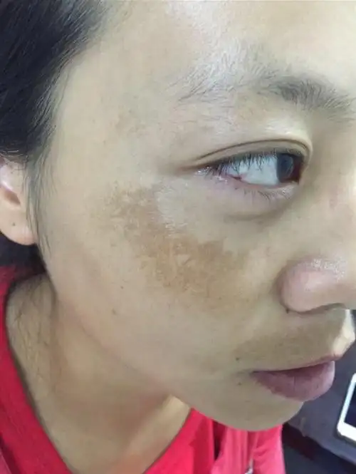 眉山黄褐斑祛除中心浅谈如何能很好的淡化褐斑