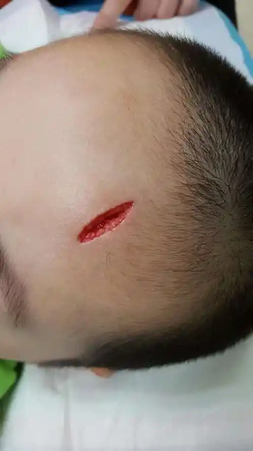 孩子头部磕流血了怎么办宝妈宝爸们一定要看原创