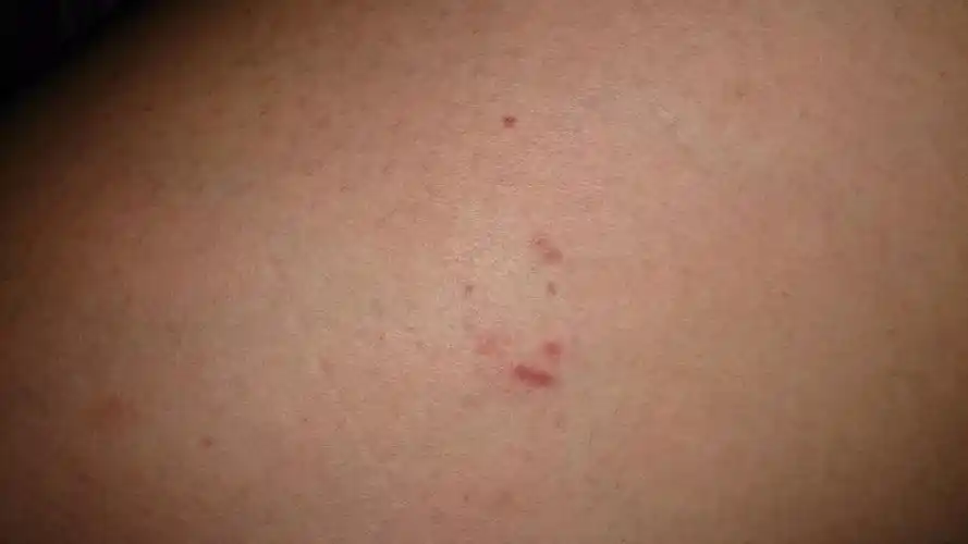 最近身上起了不少小红点,小的只有针眼大小,血红色,不疼不痒,刚发现