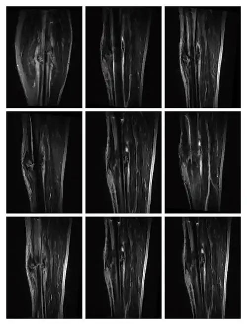 左小腿磁共振显示骨折端无明显炎症信号.
