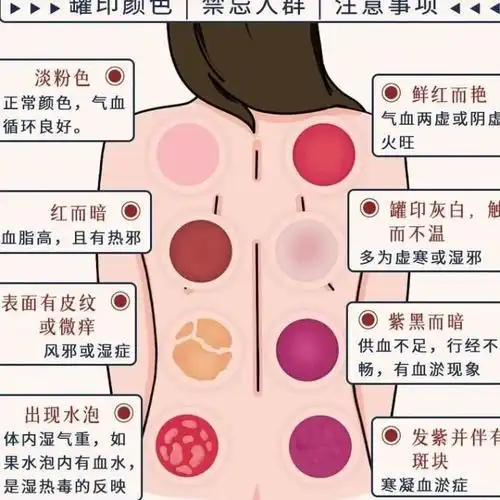 【拔罐指南】罐印颜色/禁忌人群/注意事项