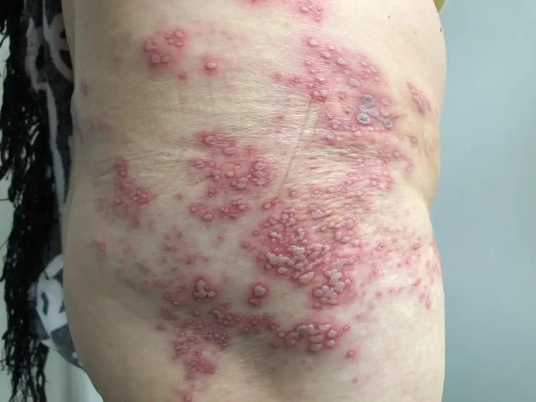 一分钟教您认识带状疱疹("生蛇","蛇串疮")_带状疱疹_症状表现_治疗