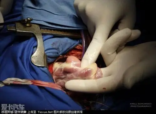 一颗鲜活心脏的手术全过程(血腥)