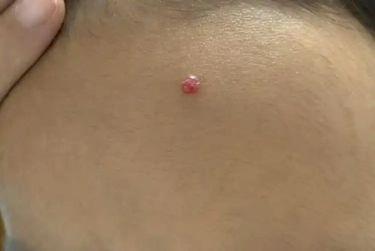 肉芽肿性血管瘤简介_血管瘤_介绍_治疗方式 - 好大夫在线