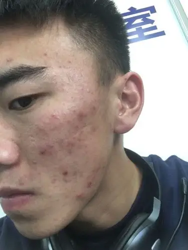 男生这种皮肤状况怎么办,能变得像那种皮肤好的男生吗