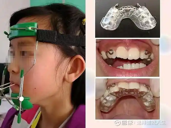 医生a:尝试前方牵引(上颌少量扩弓,后牙覆盖不一定能达到正常),治疗