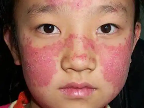 而红斑狼疮的发病因素也很多,大多数盘状红斑狼疮患者的发病可能是