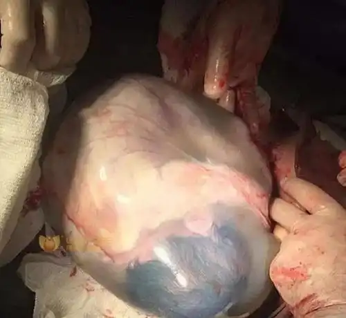 羊水没破就出生羊膜囊里蜷缩的婴儿样子真可爱