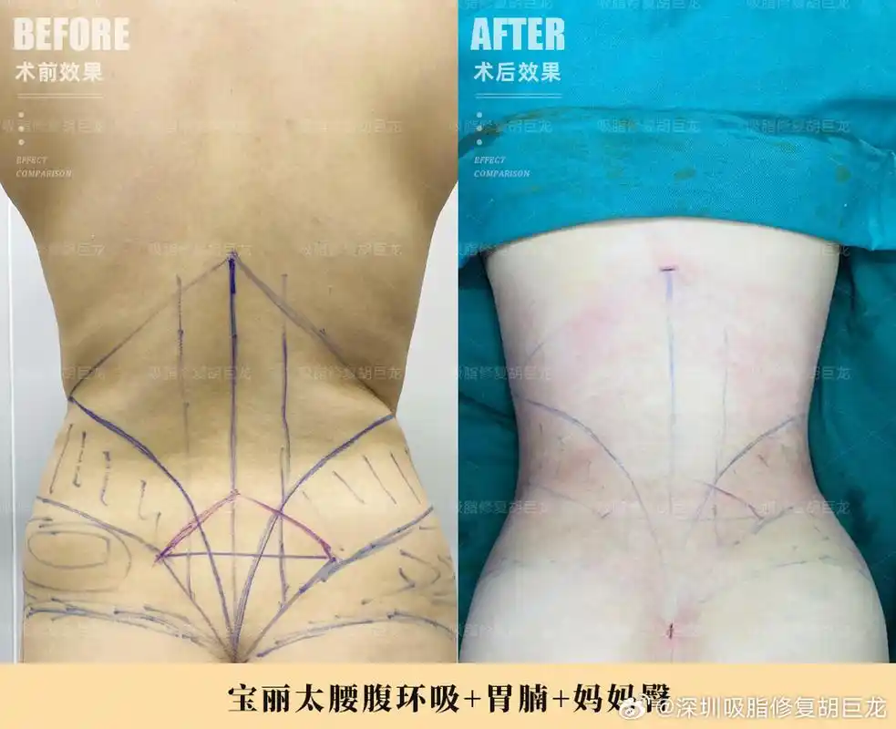【宝妈腰腹环吸 胃腩 妈妈臀术后即刻案例对比】 对于产后的宝妈,在