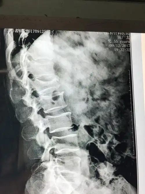 g臂透视下经皮微创钉棒骨折复位内固定术