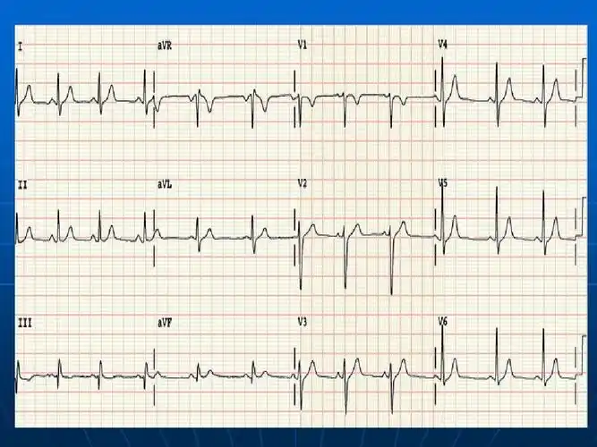 正常范围心电图ppt