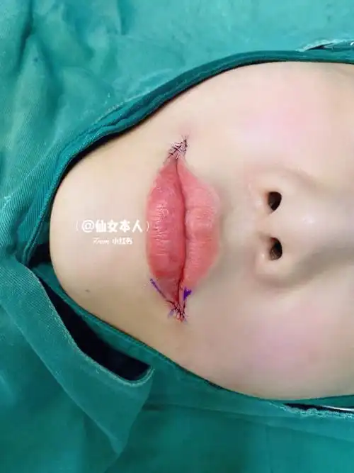 嘴角上扬术又称微笑唇手术:是在嘴角开一个小切口,把嘴的两边向上提