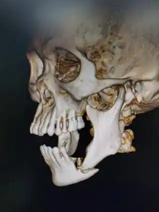 陆军特色医学中心应用创新技术治疗颌骨骨髓炎