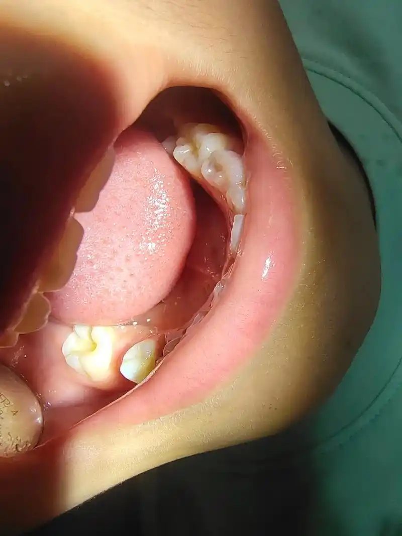 现在越来越多小孩牙齿龋坏,这是一位11岁小朋友的六龄齿.4个 - 抖音