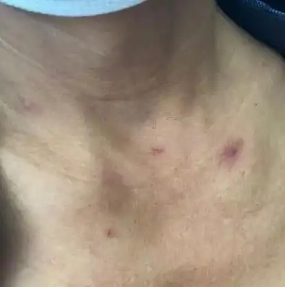 肝病患者身上长这种长小红点别大意,这叫"蜘蛛痣",是小的毛细 - 抖音