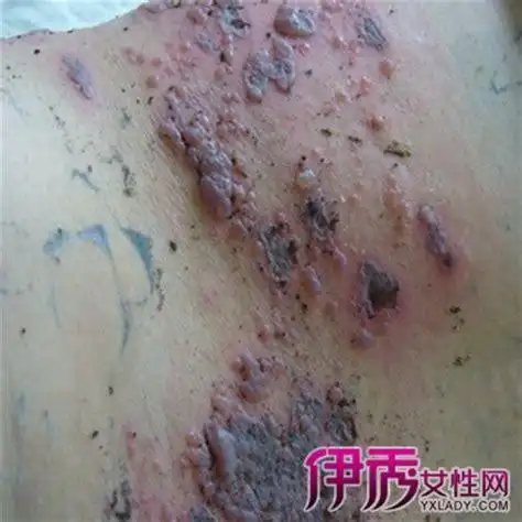 女性得生殖疱疹的症状