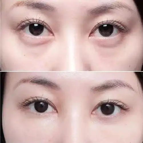 什么是泪沟这可是比眼袋更难对付的顽疾