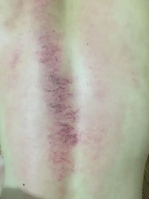 这是自己在家刮痧刮的,这样的是刮出痧了吗?