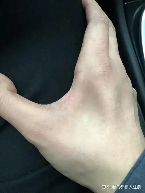 肌肉萎缩77尺神经损伤77松解手术 - 知乎