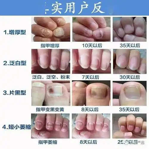一人得灰指甲全家遭殃灰指甲总是反复再生看看这里