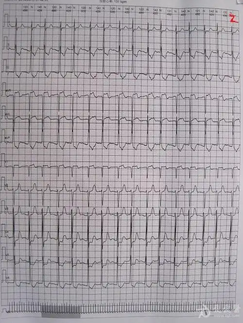 两个房早后的交界性心动过速   交界性的心动过速,不是特别齐