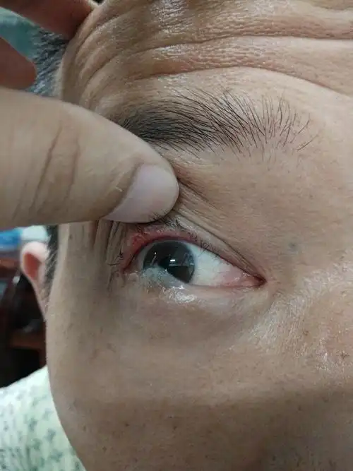 一例钢水烧伤后导致的睑球粘连的患者. - 好大夫在线