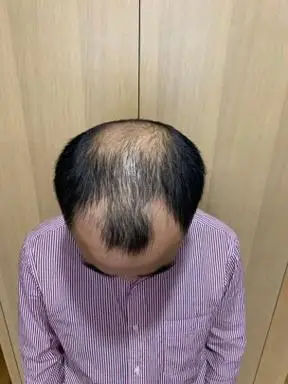 戴假发片前效果:秃机,m型脱发