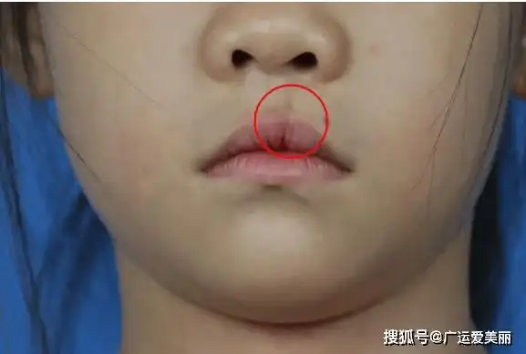 1,单纯唇裂的宝宝宜在3-6个月时手术;2,双侧唇裂的宝宝宜在6-12月时