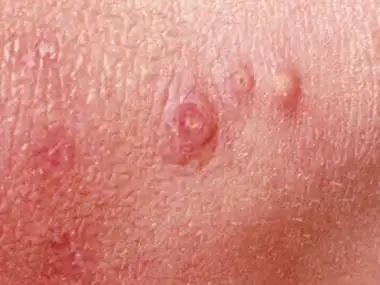 怎么感染上生殖器疱疹的呢 生殖器疱疹的症状特点有哪些?