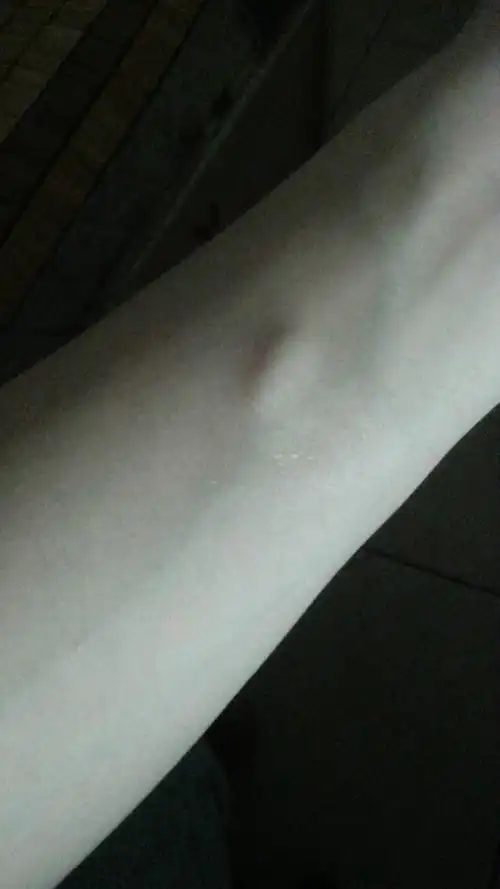 我手上长了颗皮下小疙瘩按压几下会出现头晕症状请问是什么问