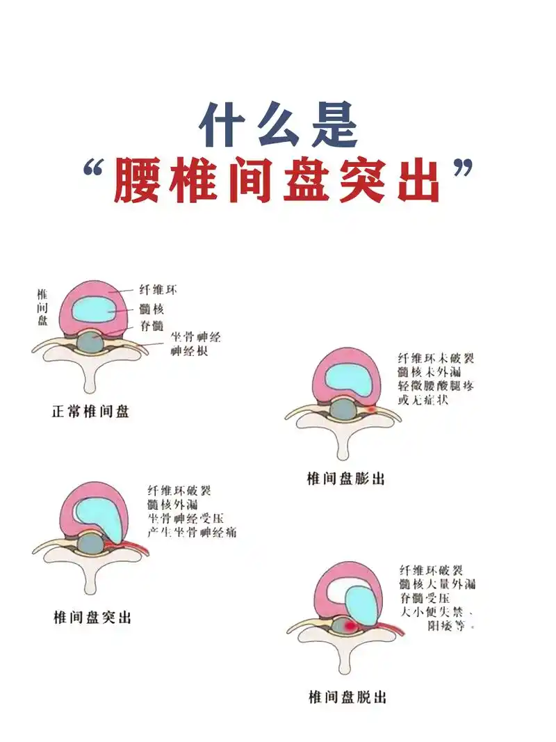 腰椎间盘突出的知识科普