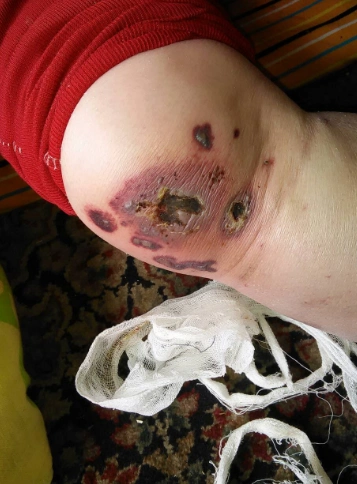 血管炎图片_血管炎症状表现图片大全_有来医生