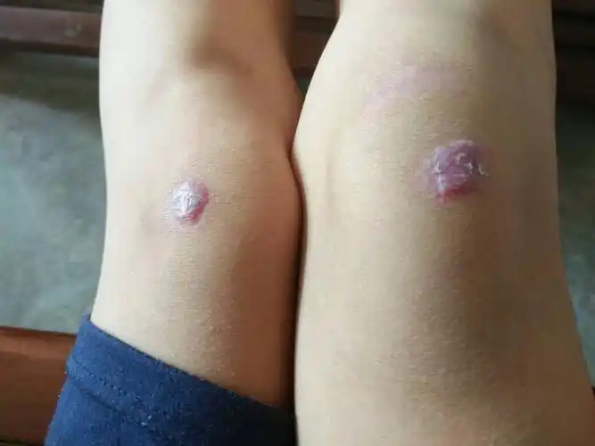 车祸结案一个多月了,但是两条腿上都了增生留疤了,还可以去找肇事司机