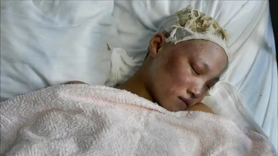 液化气爆燃致12岁女孩严重烧伤 曾经的漂亮萝莉 如今面目全非