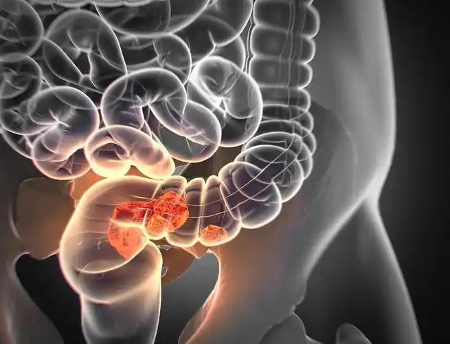 47岁男子肠子堆满粪便,查出肠癌,医生:其实大便早有"提醒"_肠道