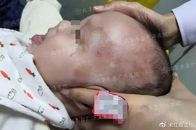 宝宝咖啡斑什么时候修复效果好