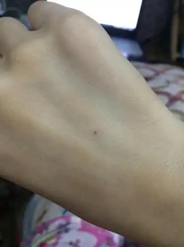 今天下午输液,晚上发现针眼儿的地方和血管