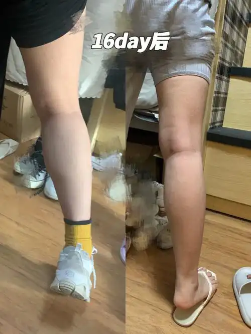 p3(小腿图解)78小腿粗壮一般是由腓肠肌