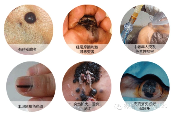 微信号:hkxgltj120 或者微信搜索 陈建平新浪微博:@血管瘤医生陈建平