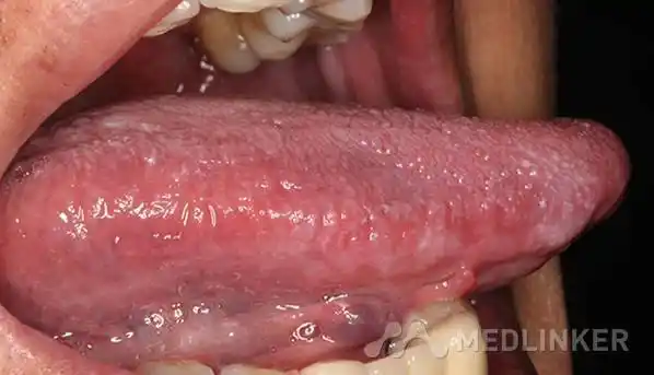 hiv感染相关的口腔念珠菌病2例