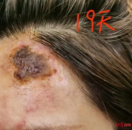 女子做医美后皮肤坏死,要求赔偿100万,悦好医学美容医院回应_曝光_新