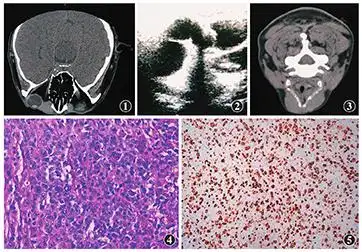 泪囊区弥漫大b细胞淋巴瘤一例